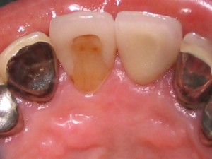 甲4　ラミネートべニア　と　オールセラミッククラウン　（後面）